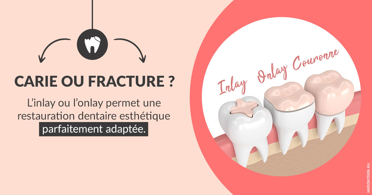 https://dr-jullien-ludovic.chirurgiens-dentistes.fr/T2 2023 - Carie ou fracture 2
