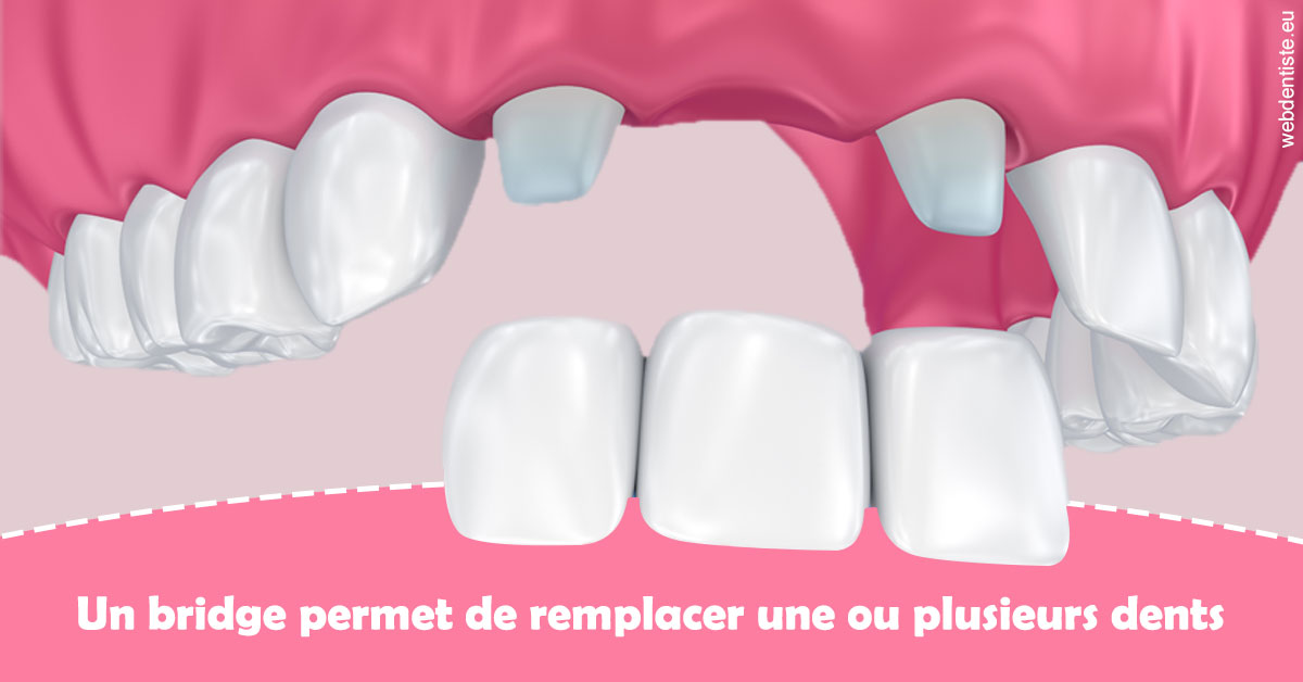 https://dr-jullien-ludovic.chirurgiens-dentistes.fr/Bridge remplacer dents 2