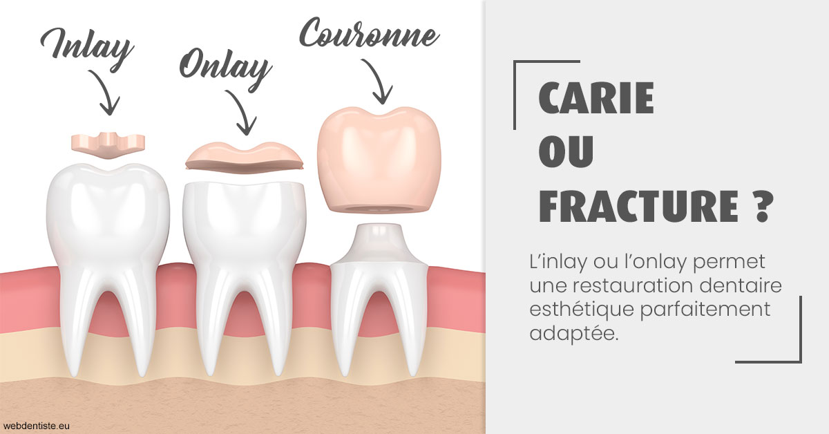 https://dr-jullien-ludovic.chirurgiens-dentistes.fr/T2 2023 - Carie ou fracture 1