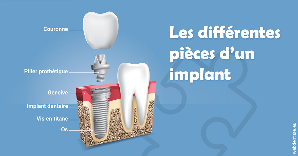 https://dr-jullien-ludovic.chirurgiens-dentistes.fr/Les différentes pièces d’un implant 1